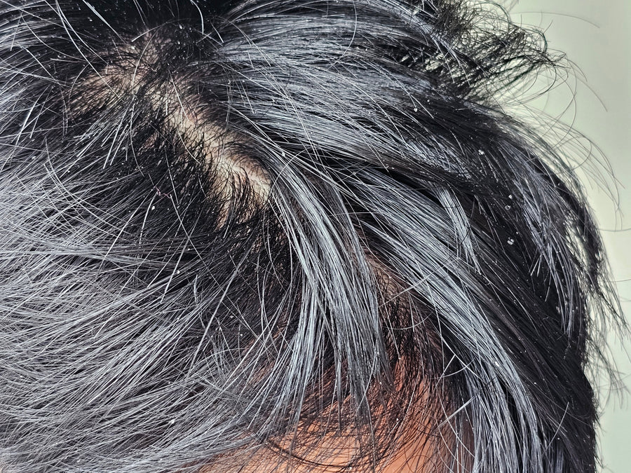 Is Your Flaky Scalp Secretly Sabotaging Your Hair Growth?